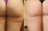 Cellulite: come mandarla via naturalmente