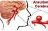 Aneurisma cerebrale: quali sono i sintomi premonitori?