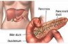 Tumore al Pancreas scoperto troppo tardi, arriva il test per la diagnosi precoce