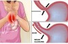 Addio al reflusso esofageo: ecco i rimedi naturali