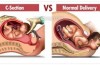 Conosci le differenze tra Parto Naturale e Parto Cesareo: Qual è meglio?