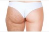 Cellulite addio: 5 rimedi veloci per eliminarla per sempre