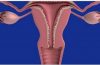 Tumore alle ovaie: sintomi, diagnosi e cura del carcinoma ovarico