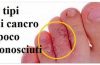 5 tipi di cancro poco conosciuti